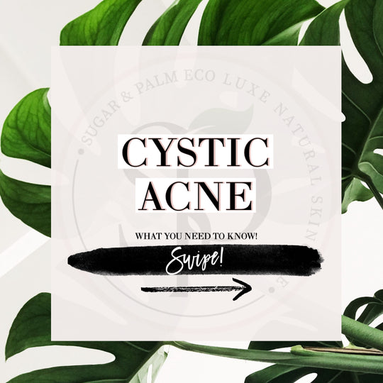 CYSTIC ACNE
